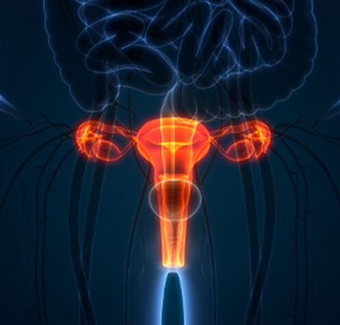 Uterine fibroids 