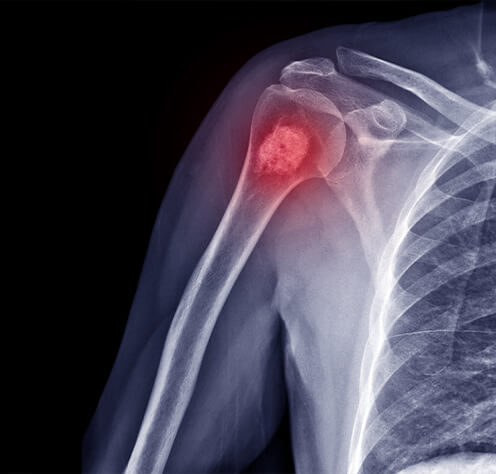 x ray of shoulder with red mark