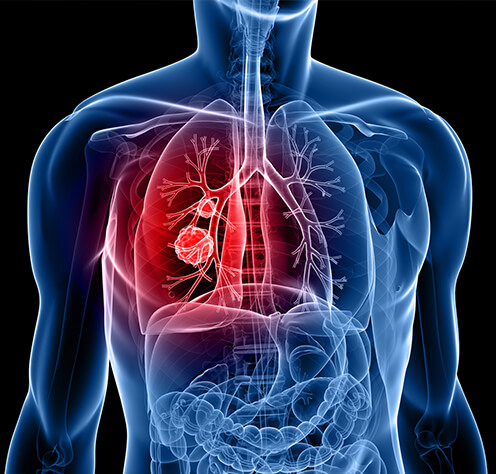 diagram of lung cancer