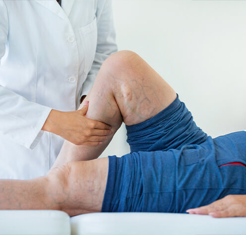 VARICOSE VEINS